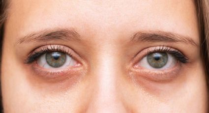 ¡Dile adiós a las ojeras! Sigue estos consejos para atenuar las bolsas