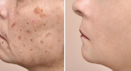 Cuidado de la piel: Elimina las manchas del rostro con pocos ingredientes