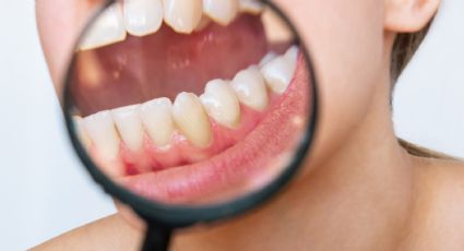 Cómo eliminar el sarro de los dientes con estos secretos naturales